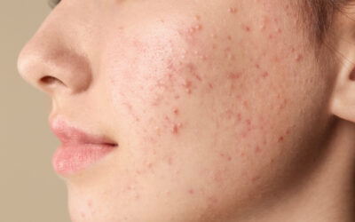 Fungal Acne Vs Hormonal Acne: How To Identify & Treat It?