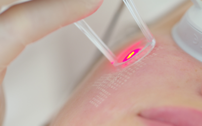 Benefits Of Laser Skin Resurfacing