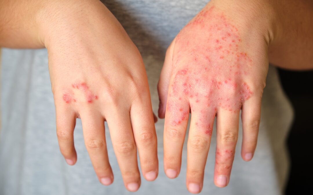 Psoriasis Vs Eczema — What Is The Difference?