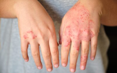 Psoriasis Vs Eczema — What Is The Difference?